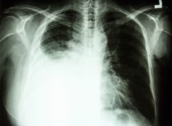 Xray of lung cancer