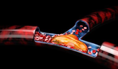 Xeljanz is prescribed for UC, but tied to blood clots