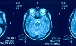 Brain MRI