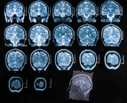 Brain mri scan