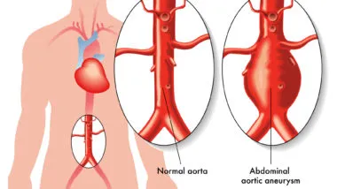 Diagram of aortic aneurism