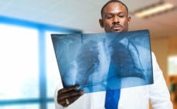 Doctor looking at lung xray