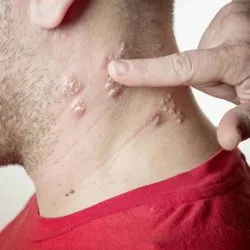 Shingles on an adult male neck