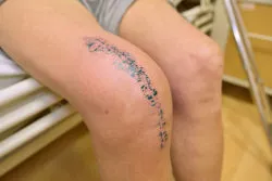 Revision total knee replacement patient shows substantial scar.