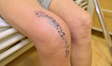 Revision total knee replacement patient shows substantial scar.