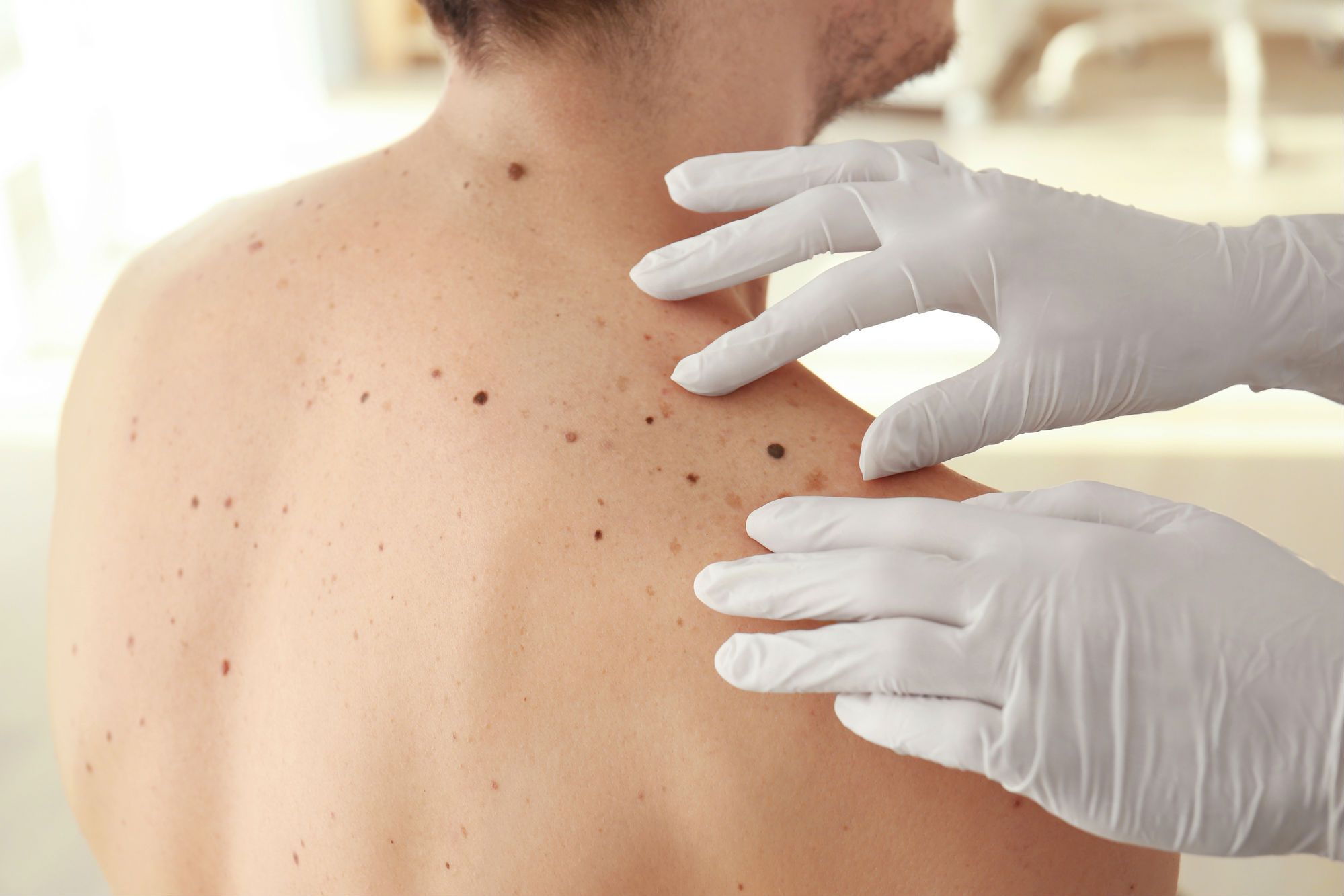 Malignant Melanoma has been diagnosed more frequently among users of the erectile dysfunction (ED) medication known as Viagra.