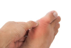 A heart attack is a possible side effect of Uloric, a drug to treat gout.