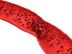 clot in vein on white