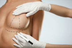 Saline breast implant illness is affecting women all over the country.