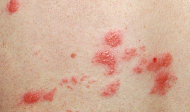 Adults over 50 are concerned about the possibility of getting shingles after being vaccinated.