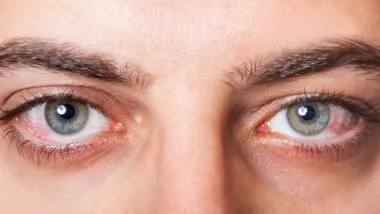 close up of bloodshoot eyes