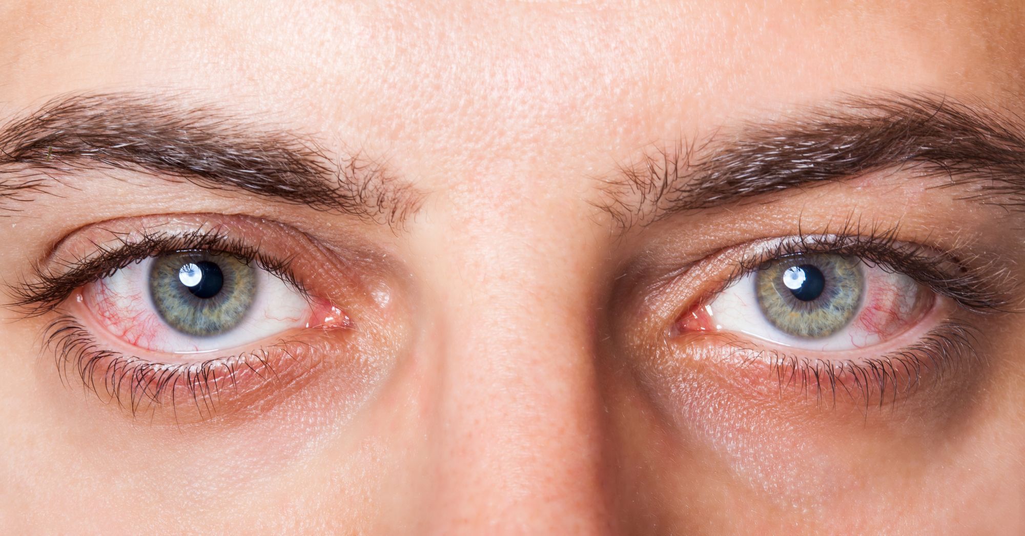 close up of bloodshoot eyes