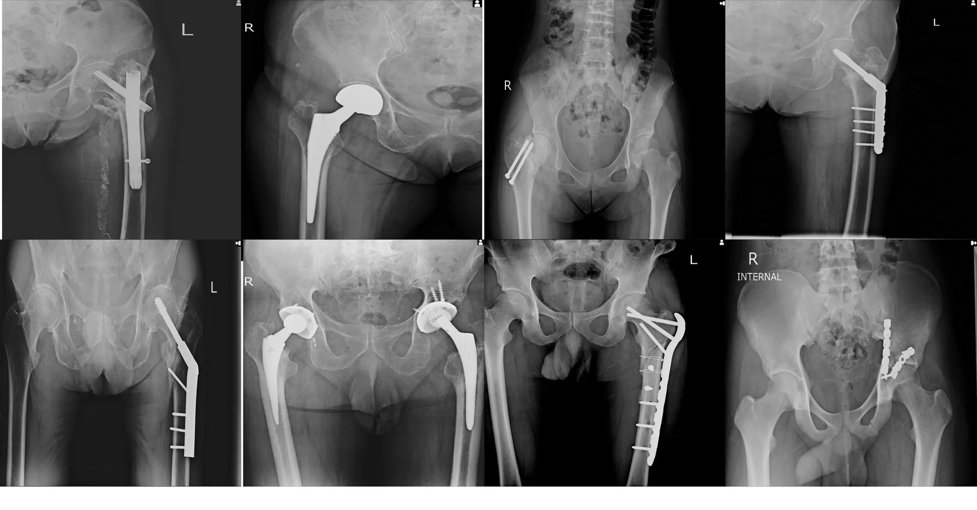 X-rays of artificial hips