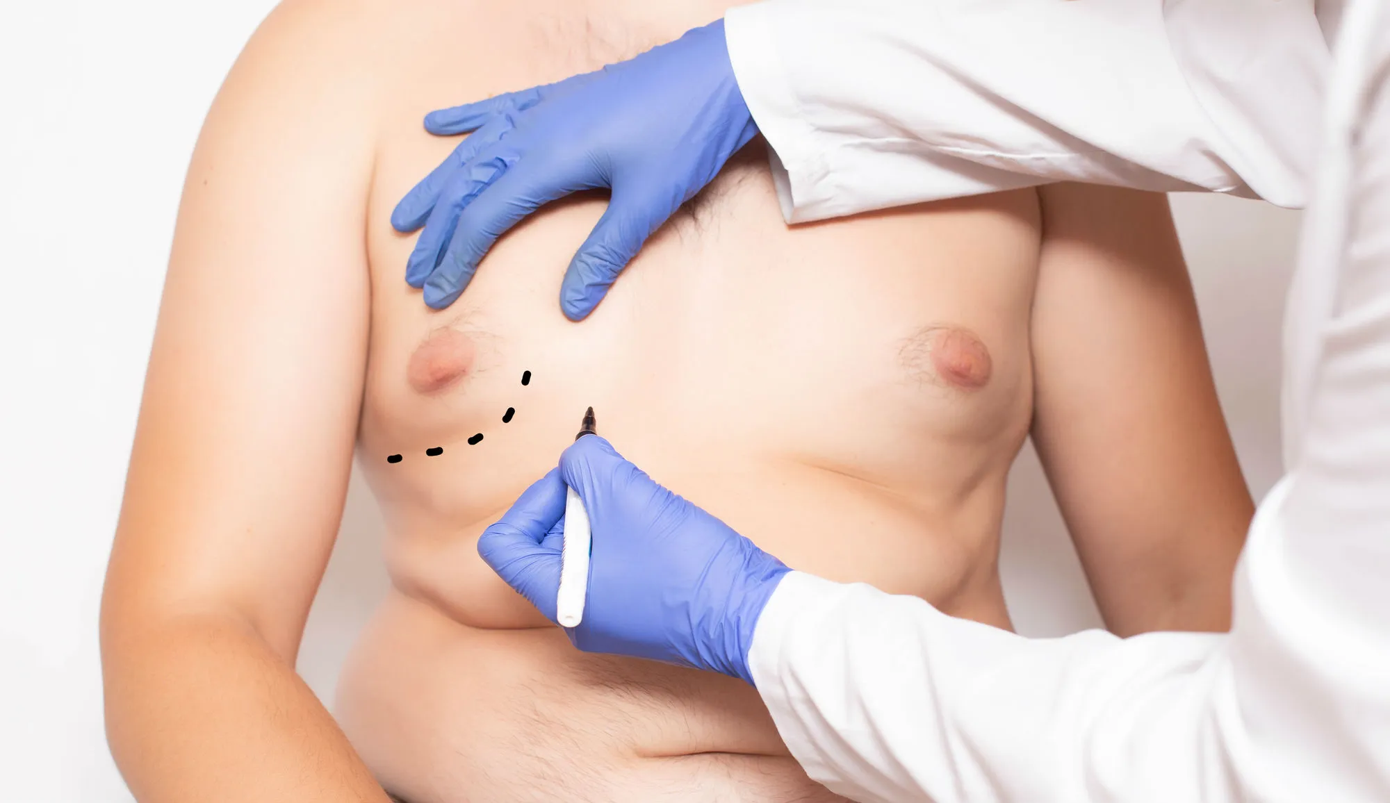 Corrective surgery may be necessary to correct gynecomastia with Risperdal use.