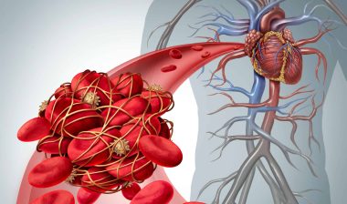 Blood clot filter