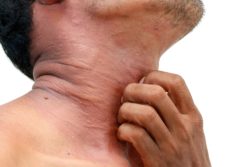 Rash with Lamictal.