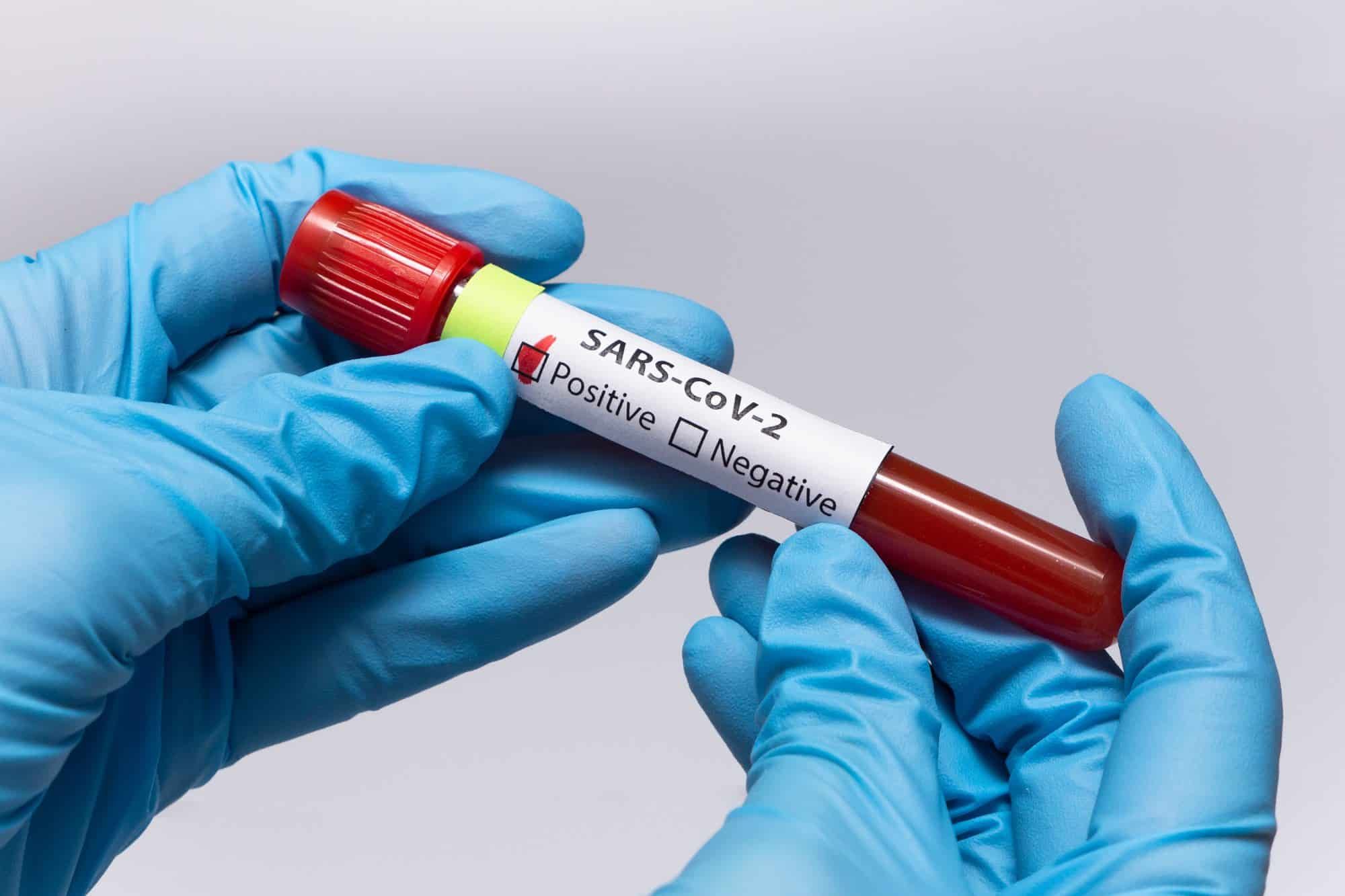 Tyson Foods Inc. employee COVID-19 test