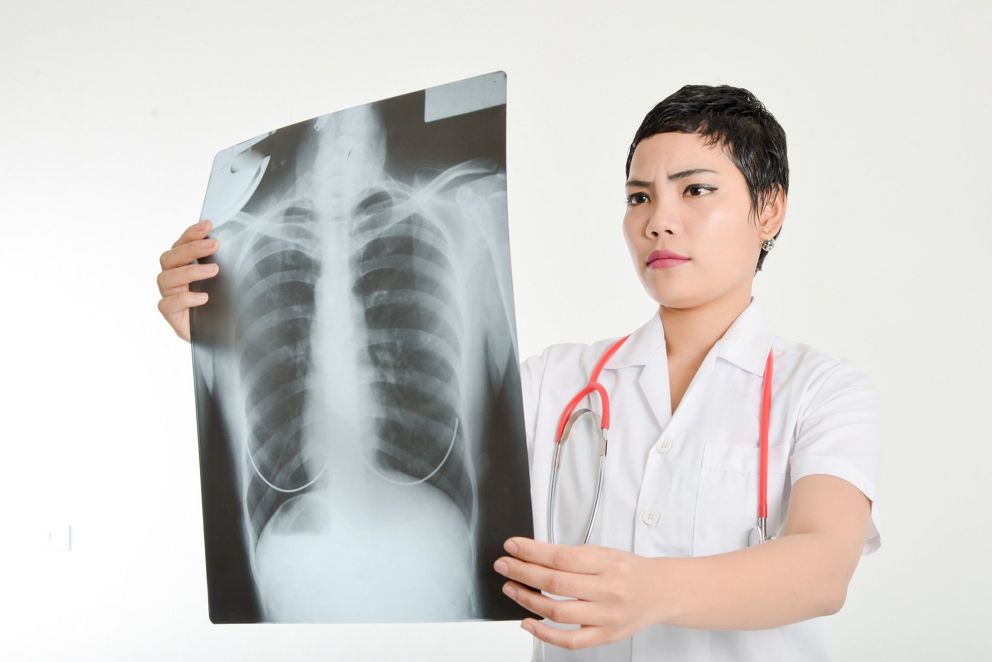Asbestosis disease