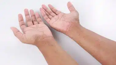 arms and hands with allergic rash