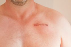 Surgical staple injury