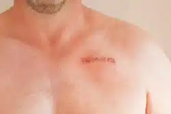 Surgical staple injury