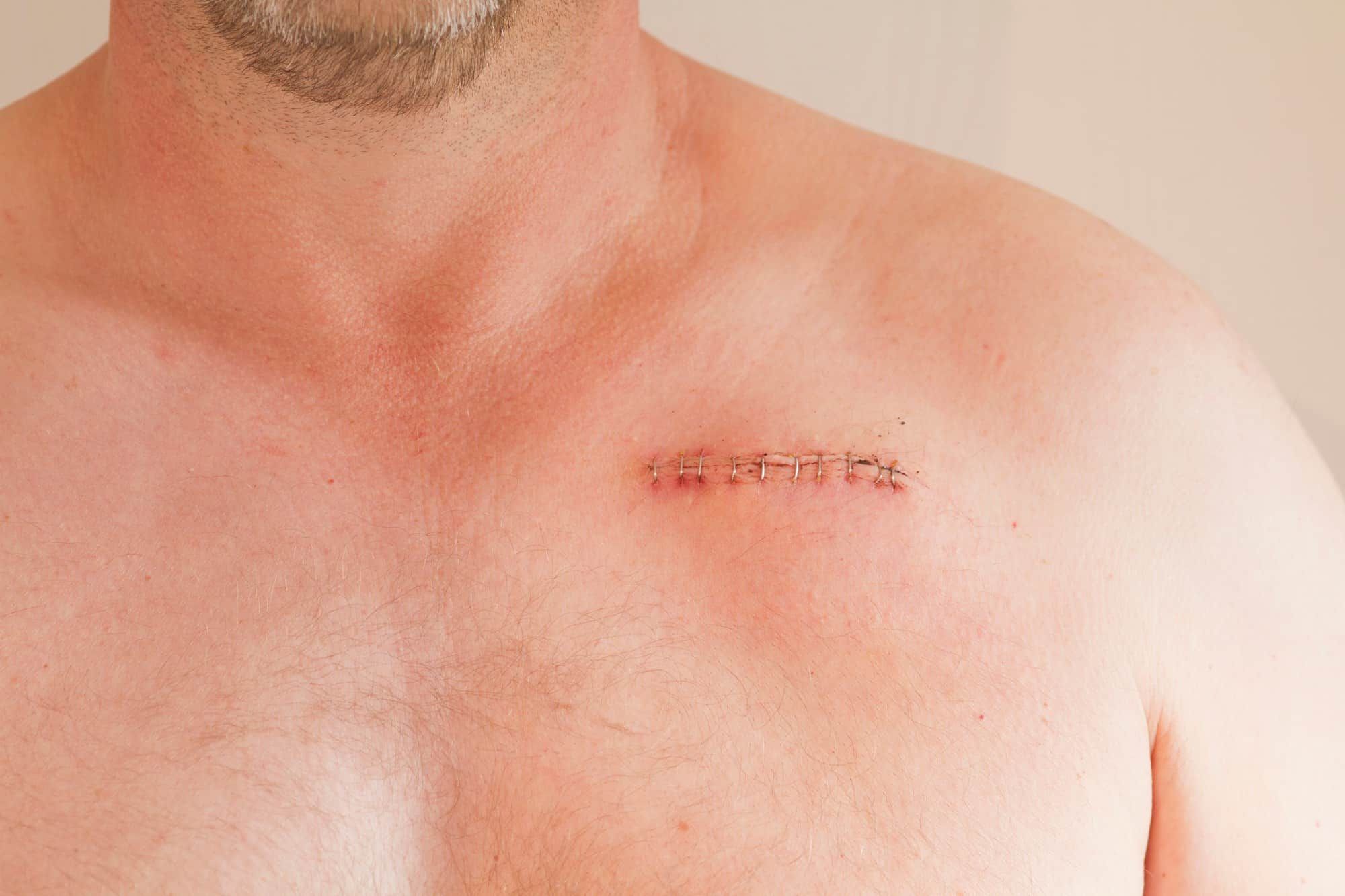 Have You Experienced a Surgical Staple Injury? Top Class Actions