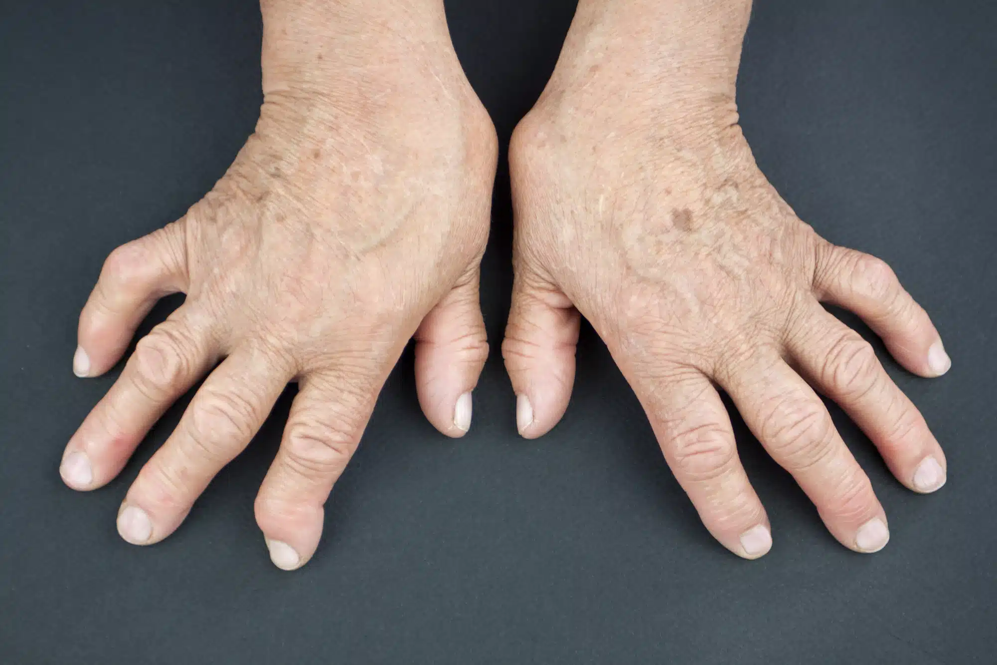 Hands Of Woman Deformed From Rheumatoid Arthritis