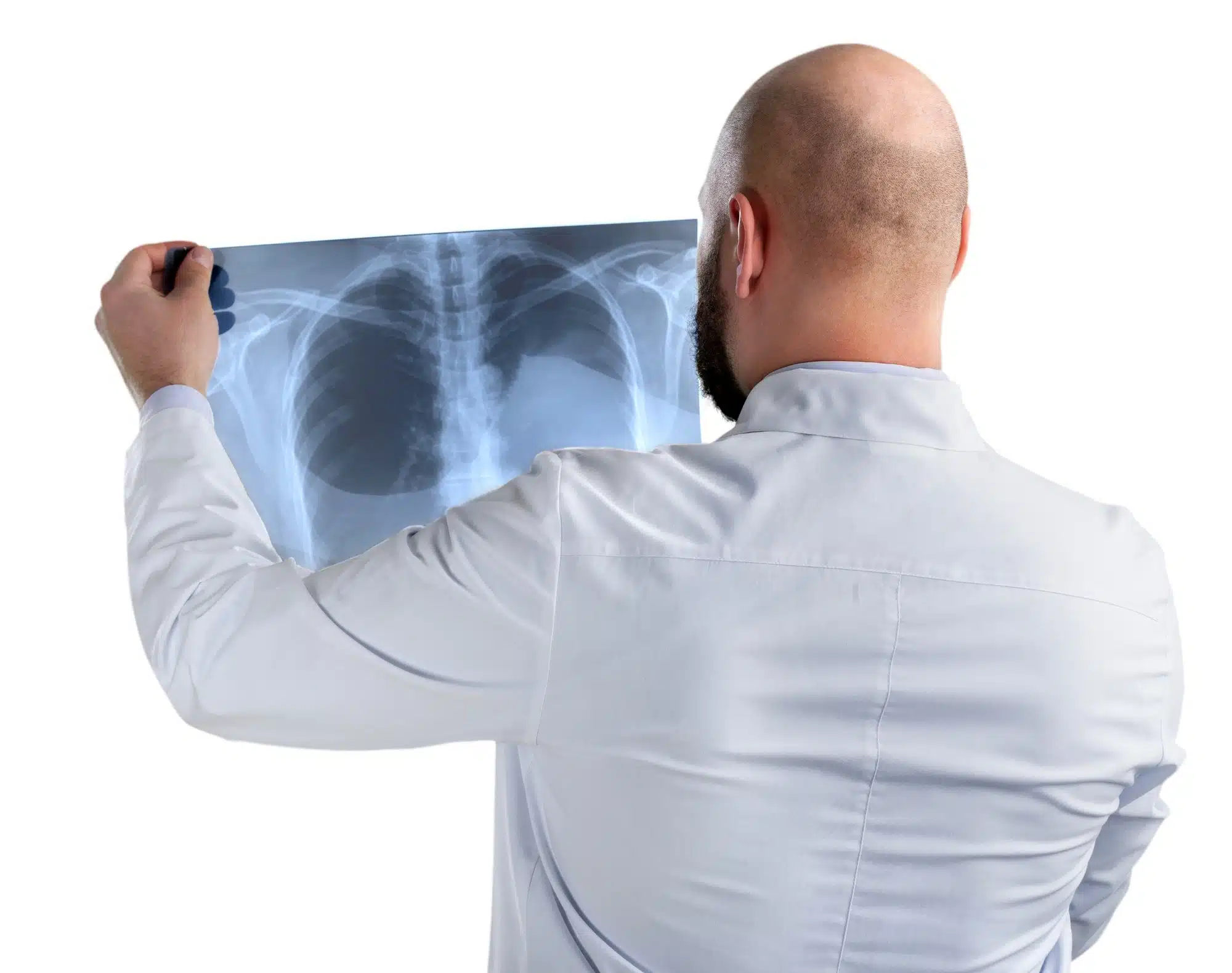 Vaping lung illness xray