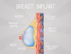 breat implant diagram