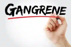 Symptoms of necrotizing faciitis