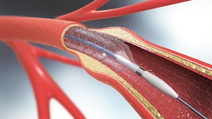 Penumbra catheter recall