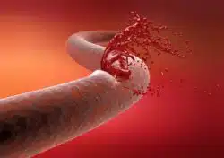 Why are there Penumbra catheter deaths?