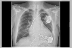 imaging of heart with pacemaker