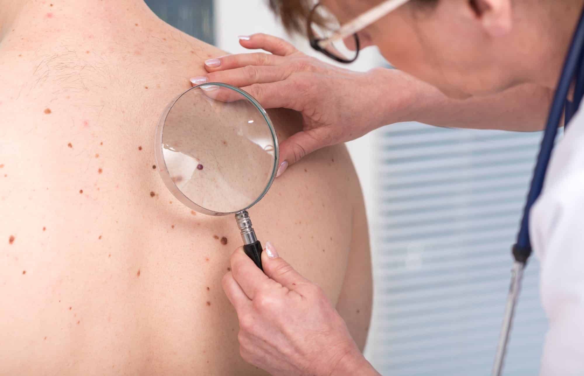 Picato skin gel has given people skin cancer, according to a class action lawsuit.