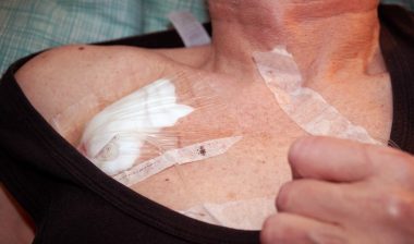 elderly patient with a Port catheter for injecting the fluid drug in the hospital wardroom. PowerPort problems may include infections, clotting, bleeding, pain and death.