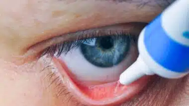 Close up of eye ointment being put into eye, representing the eye ointment recall.