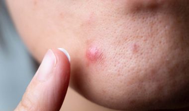 Close up of woman putting acne spot treatment cream on a pimple, representing the Johnson & Johnson class action.