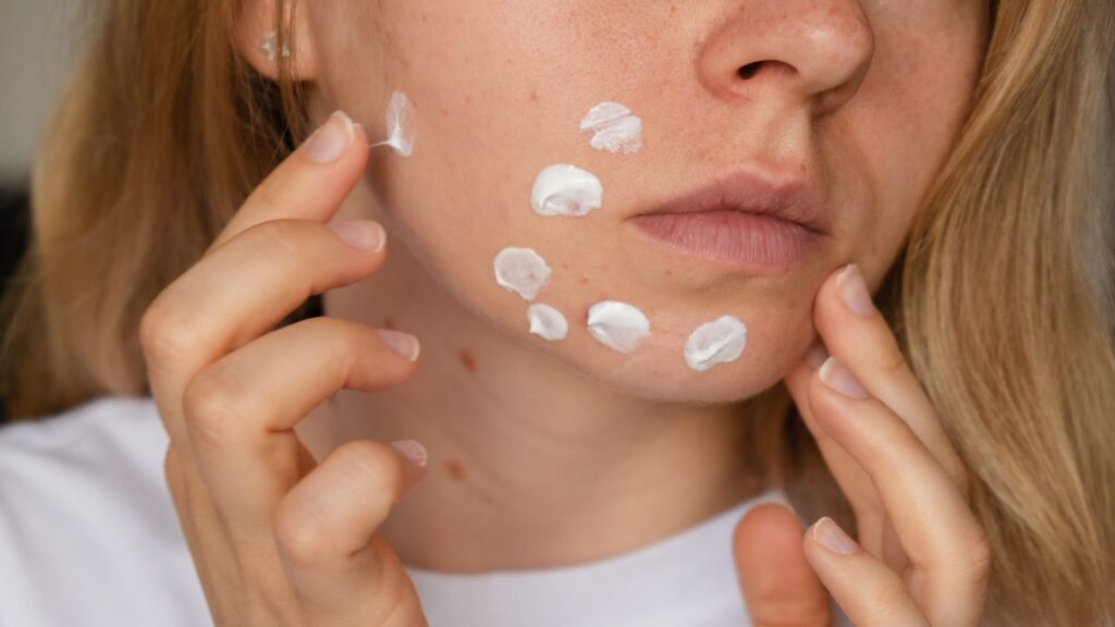 woman applies, cream serum cure for acne on face.