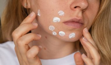 woman applies, cream serum cure for acne on face.