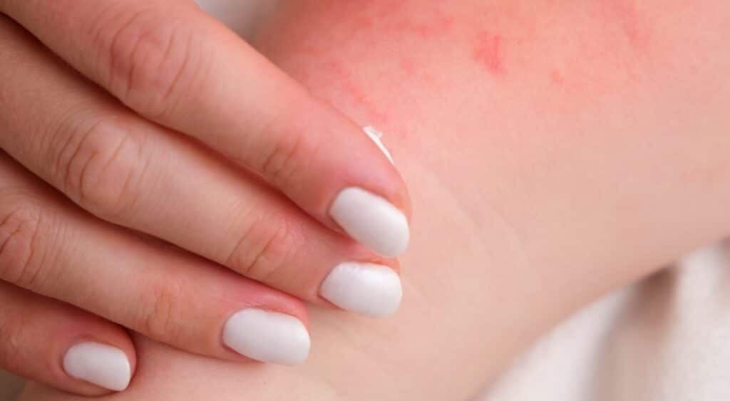 A woman is treating her baby's eczema with a special cream.