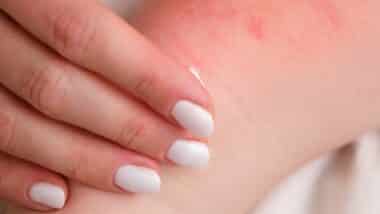 A woman is treating her baby's eczema with a special cream.