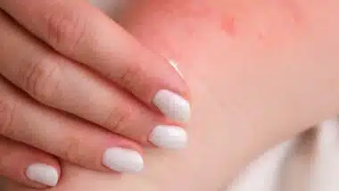 A woman is treating her baby's eczema with a special cream.