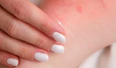 A woman is treating her baby's eczema with a special cream.