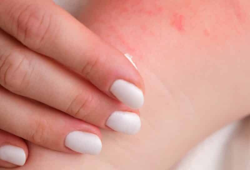 A woman is treating her baby's eczema with a special cream.