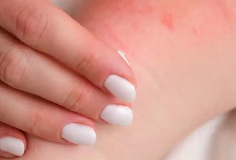 A woman is treating her baby's eczema with a special cream.