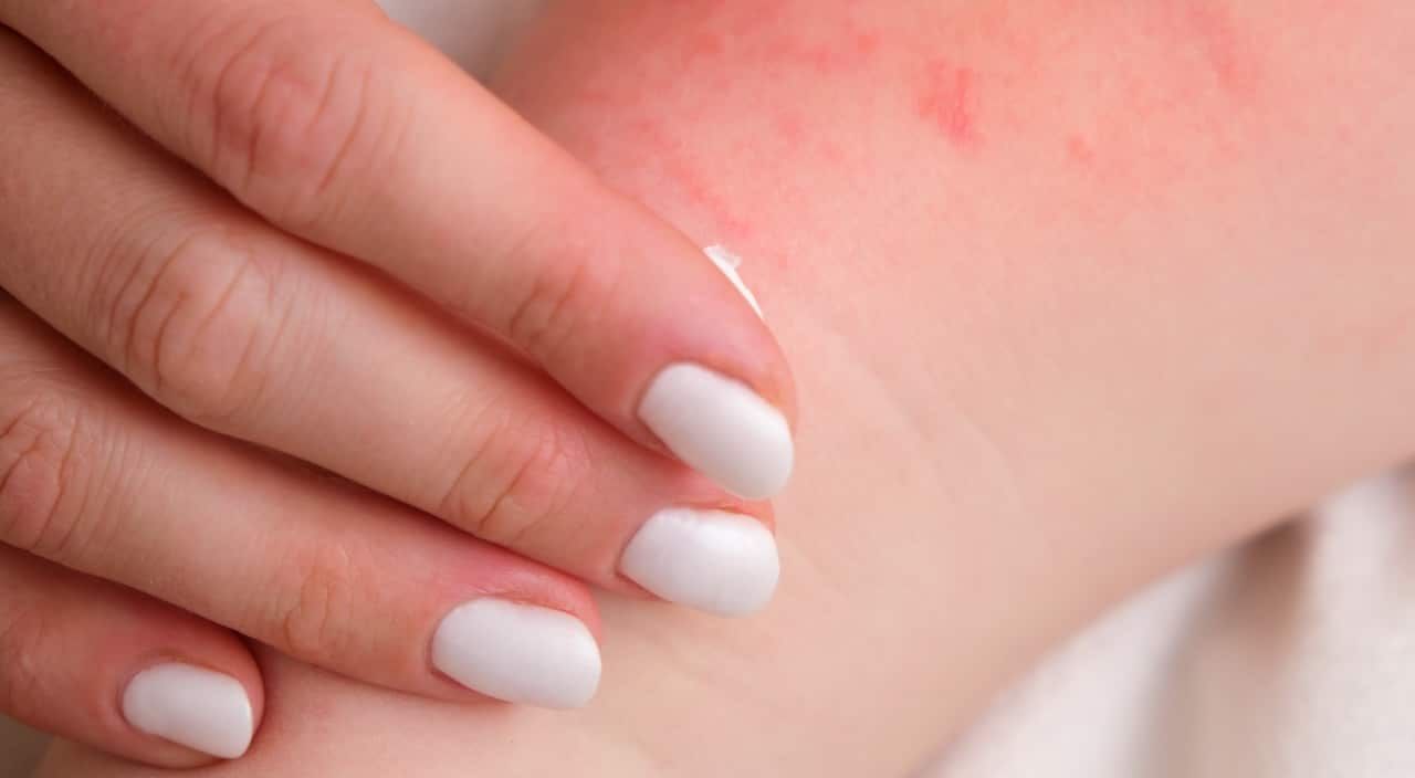 A woman is treating her baby's eczema with a special cream.