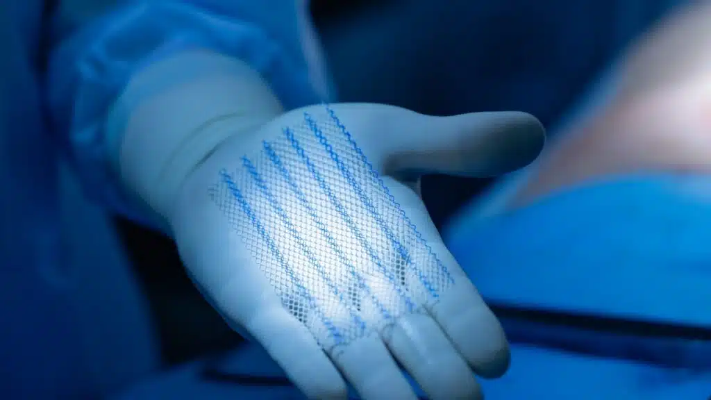Surgeon's gloved hand displaying medical mesh after umbilical hernia removal under blue light.